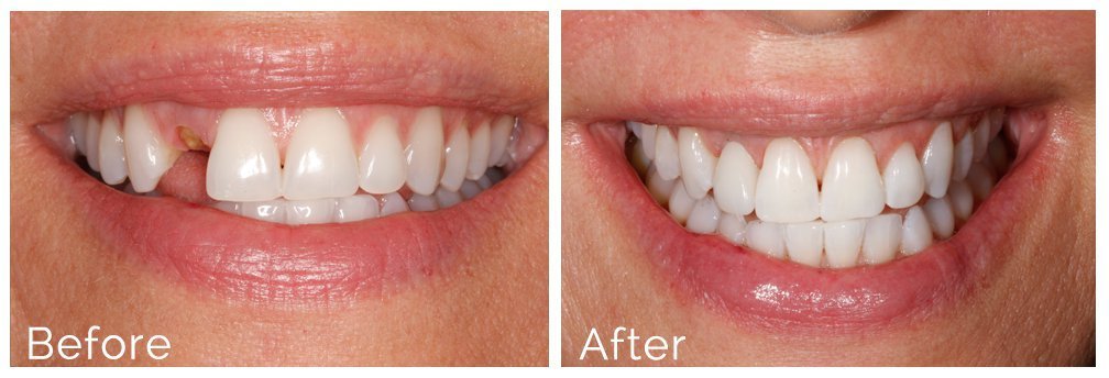 Dental implants before and after treatment